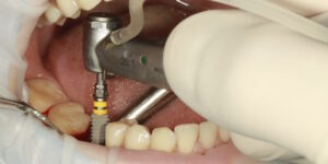 Implantologia a carico immediato