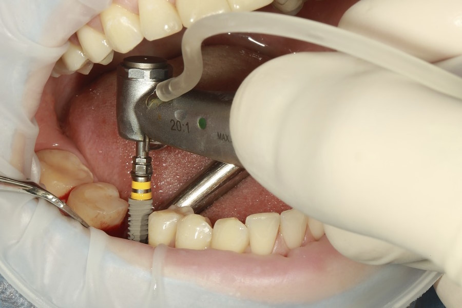 Implantologia a carico immediato