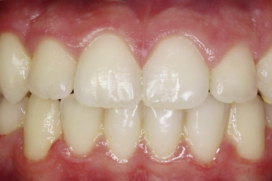 Ortodonzia per la correzione del sorriso