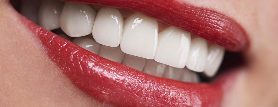 Gli impianti dentali All-on-four