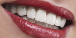 Gli impianti dentali All-on-four