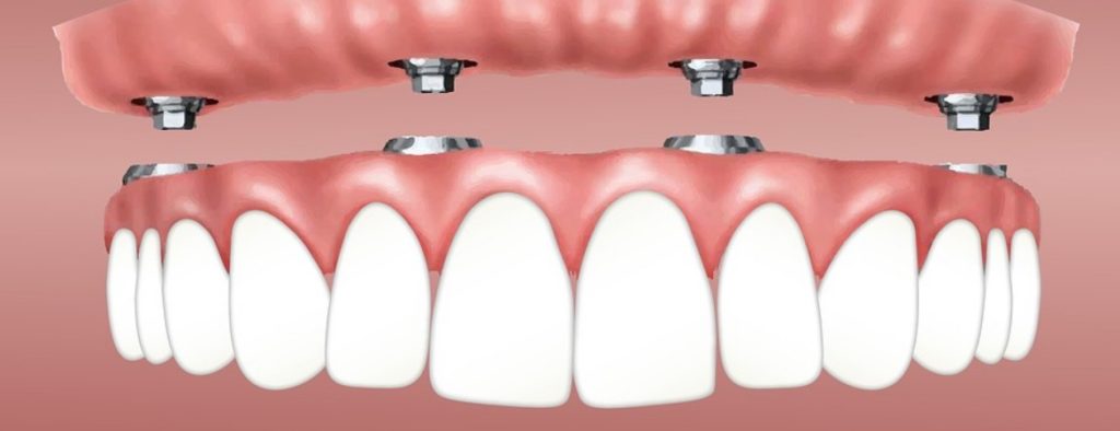 Impianti dentali All-on-four