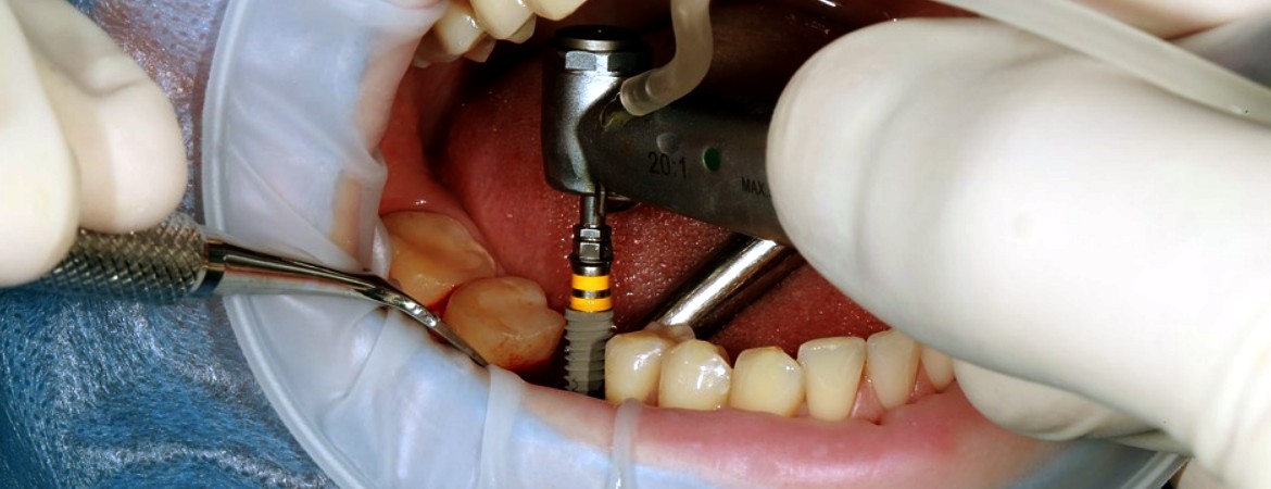 Implantologia a carico immediato