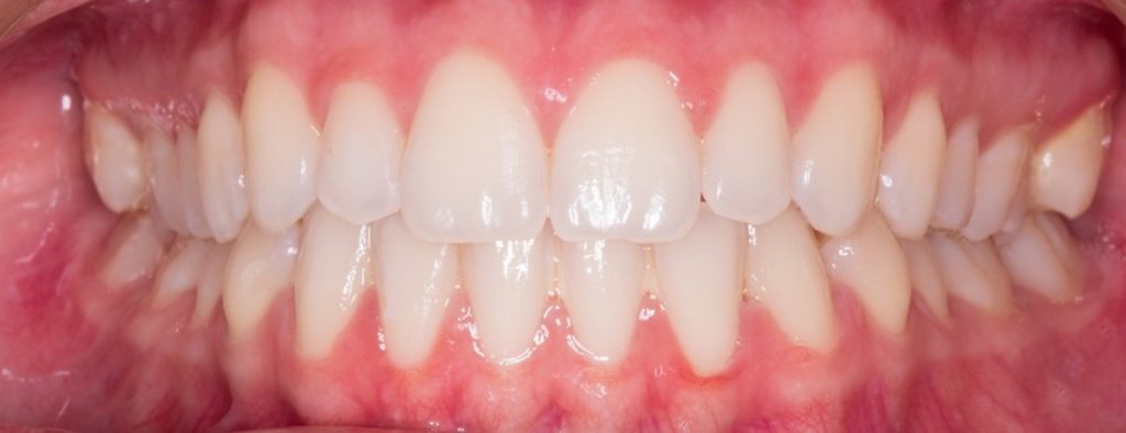 Ortodonzia per la correzione del sorriso