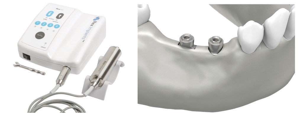 Le creste sottili sono un problema risolto