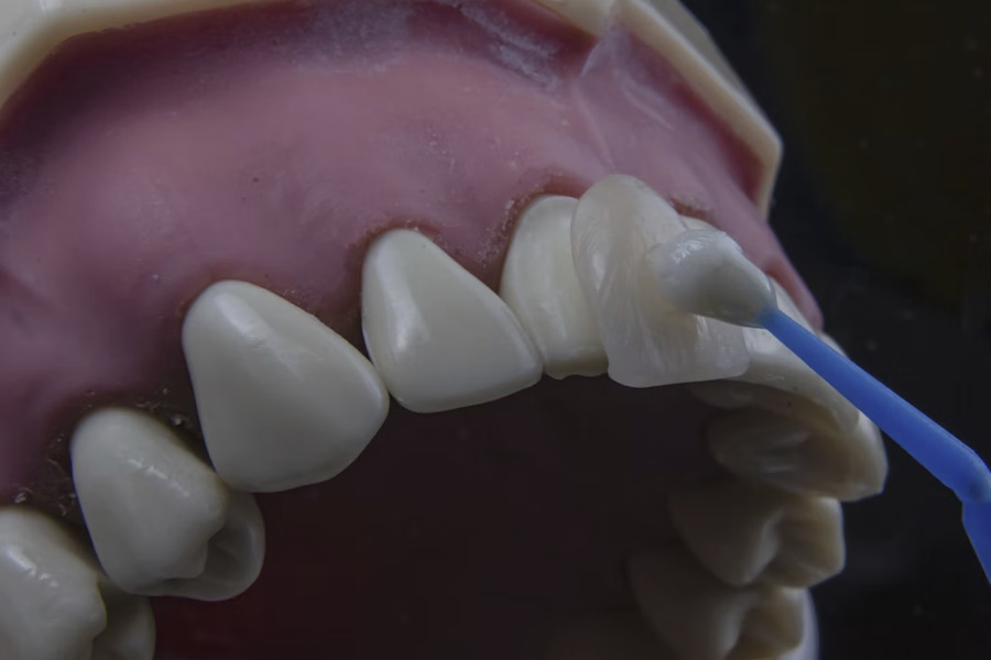 Come si applicano le faccette dentali