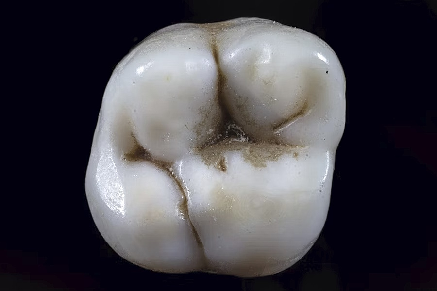 Le carie dentali rappresentano un problema comune