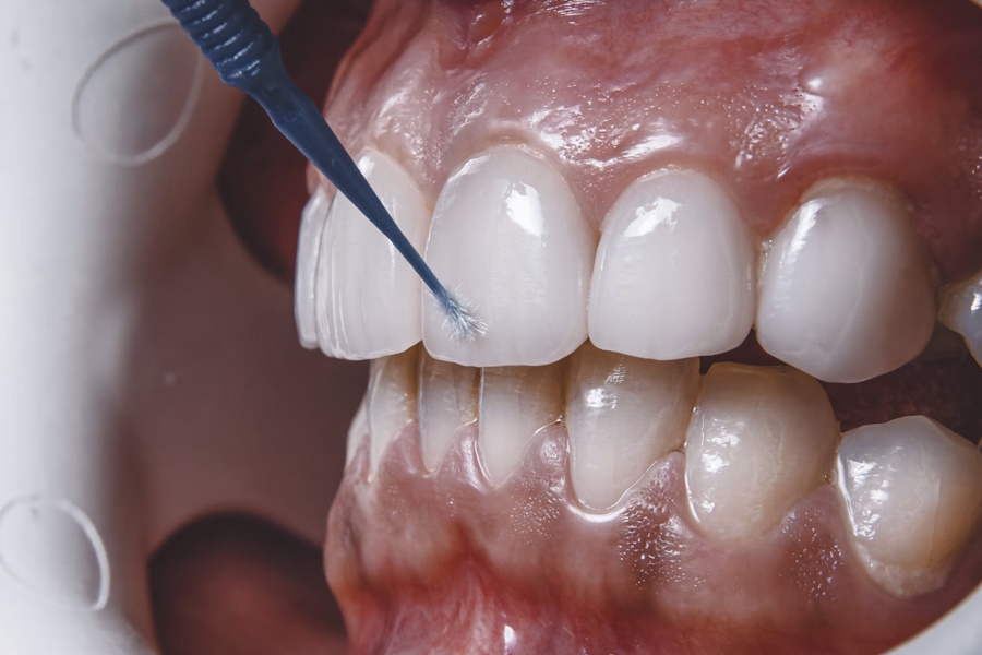 Che cosa sono le faccette dentali