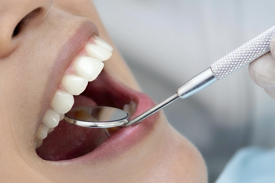 Faccette dentali: migliorare l'aspetto del sorriso