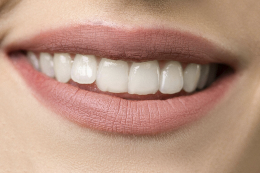 Faccette dentali: migliorare l'aspetto del sorriso