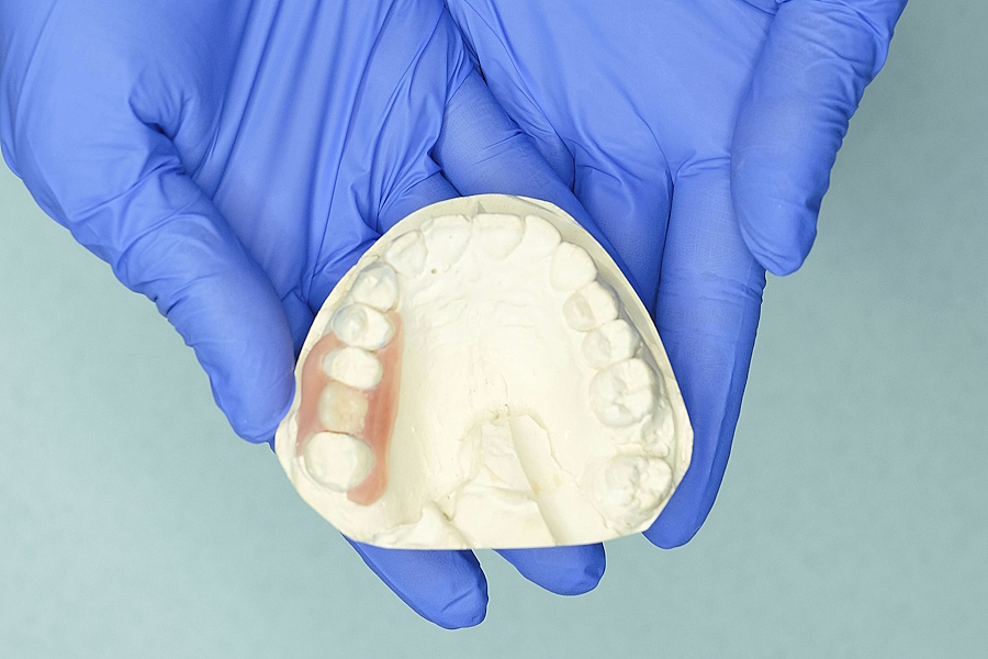 Le protesi mobili in nylon