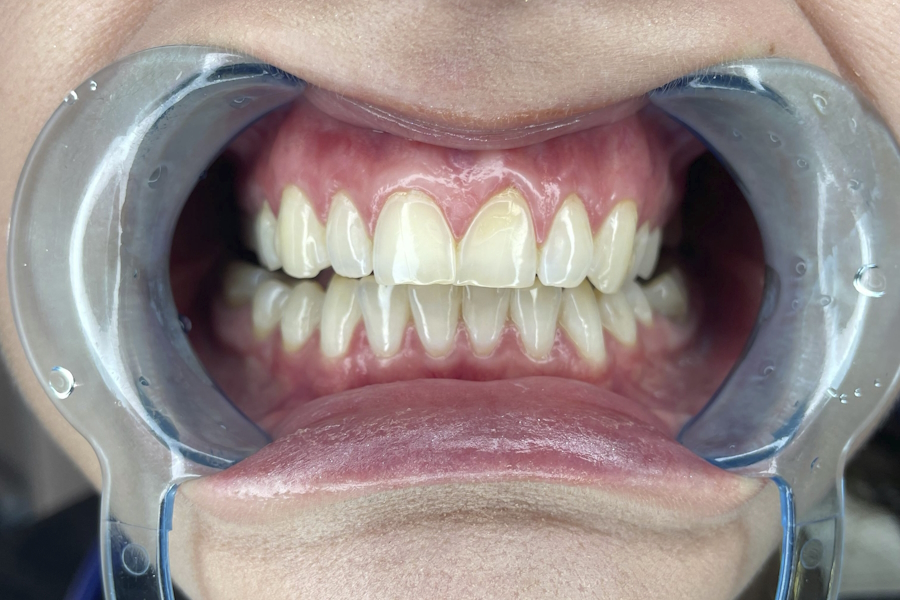 Trattamenti di sbiancamento dentale