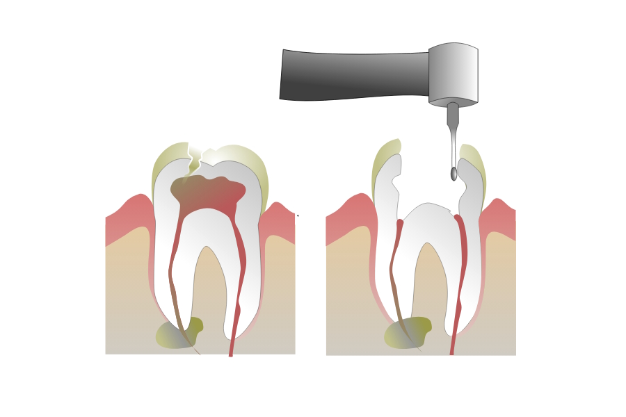 Devitalizzazione: il trattamento endodontico