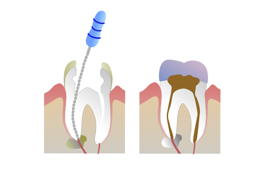 Devitalizzazione: il trattamento endodontico