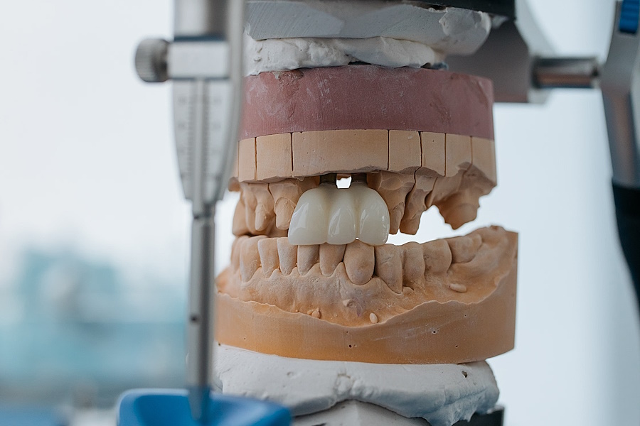Sostituire un dente mancante