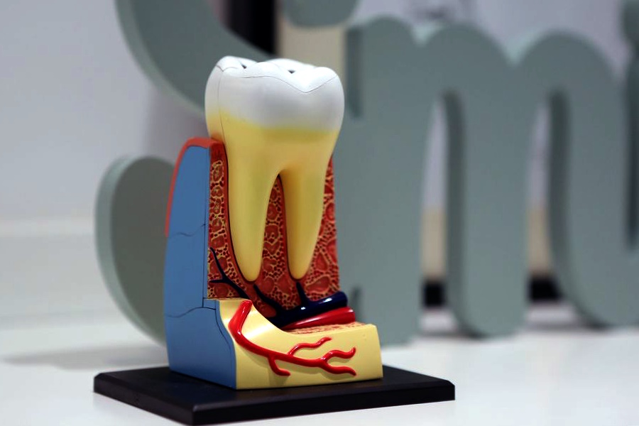 Sostituire un dente mancante