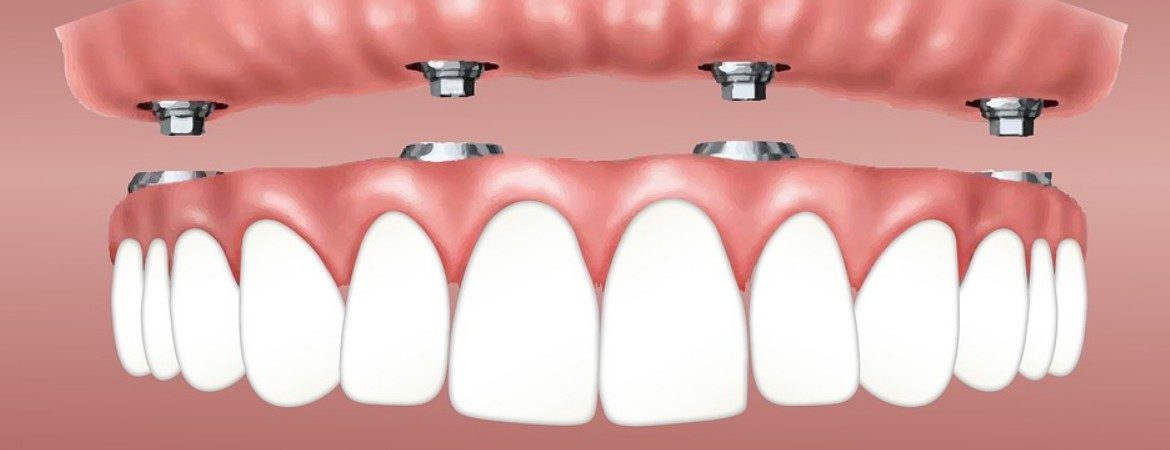 Impianti dentali All-on-four