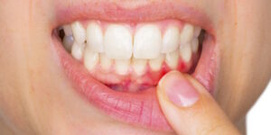 Terapia indolore per la Parodontite