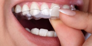 Allineatori trasparenti nell’Ortodonzia moderna