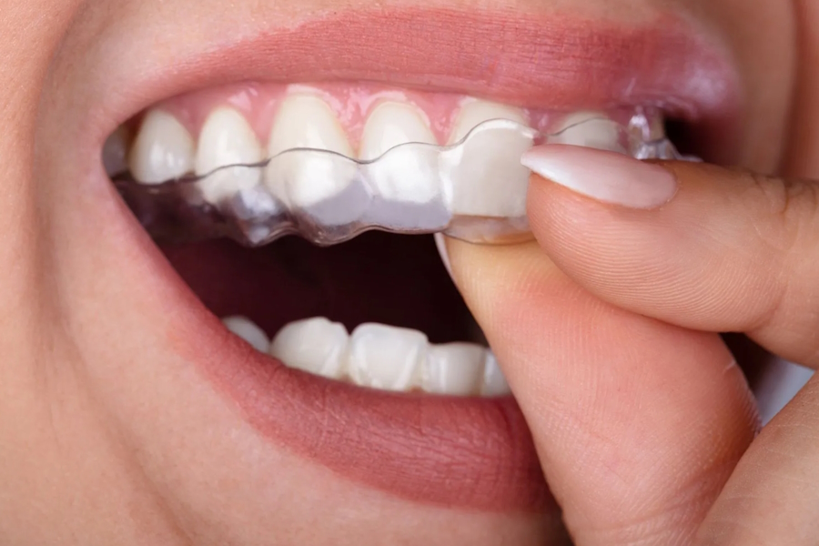 Allineatori trasparenti nell’Ortodonzia moderna