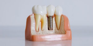 Sostituire un dente mancante