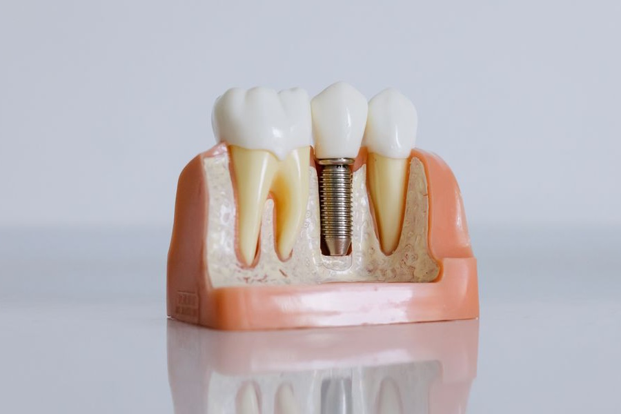 Sostituire un dente mancante